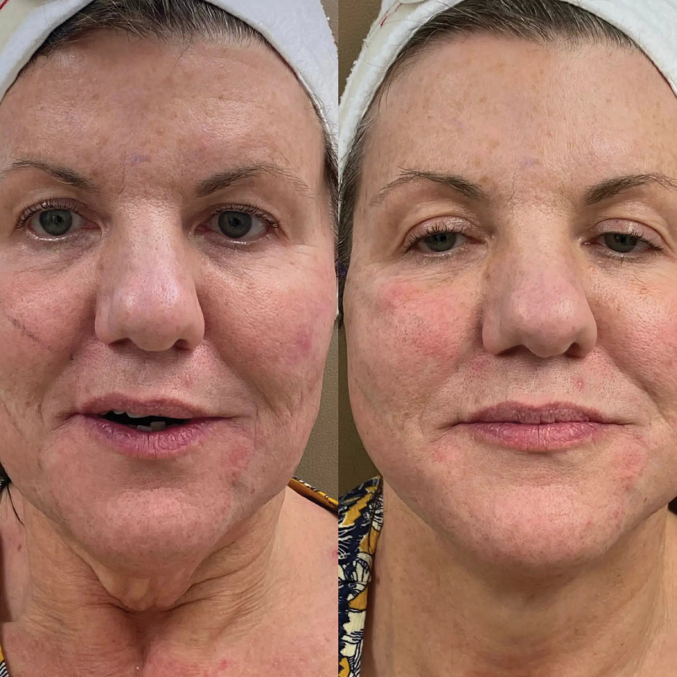 Before And After
