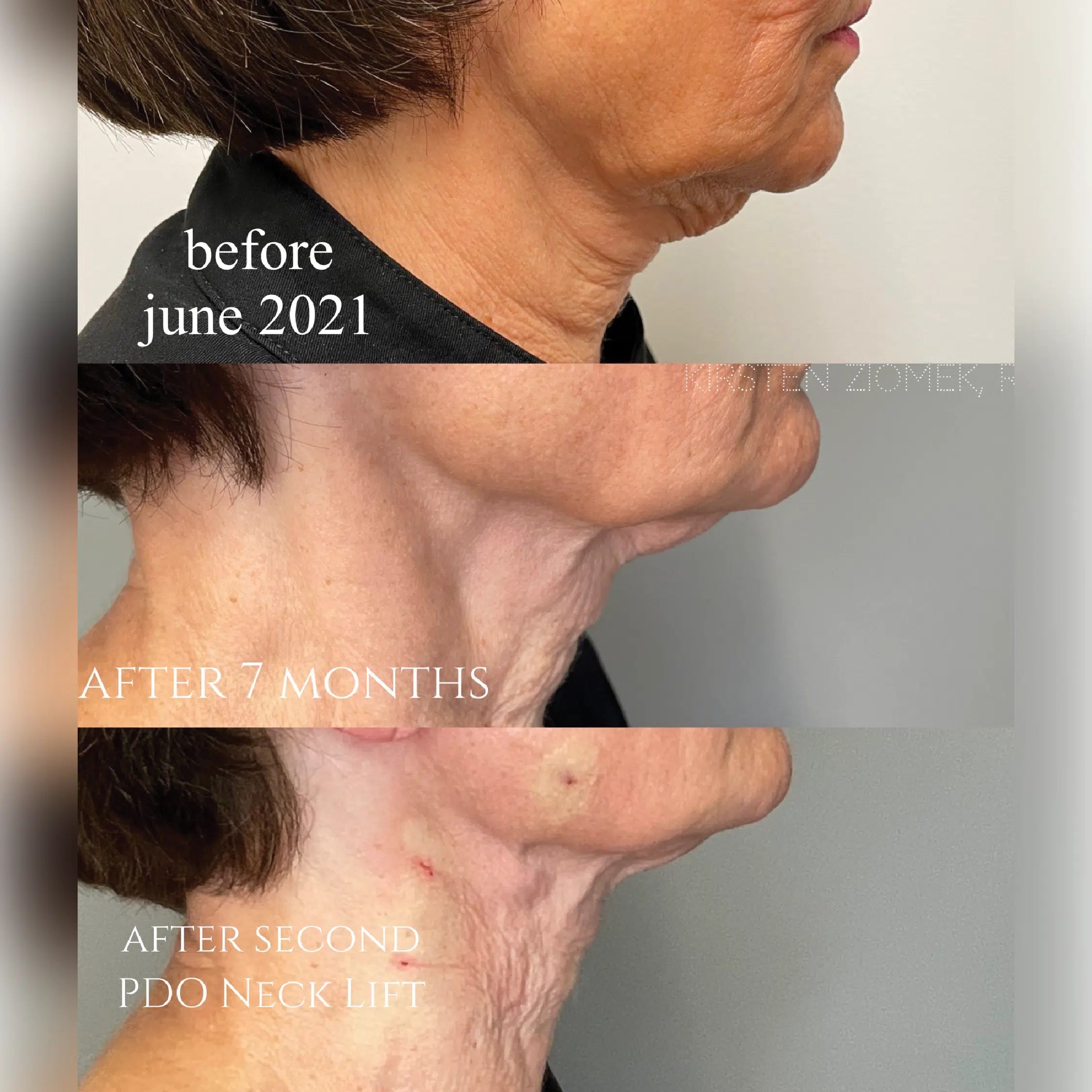 Before And After